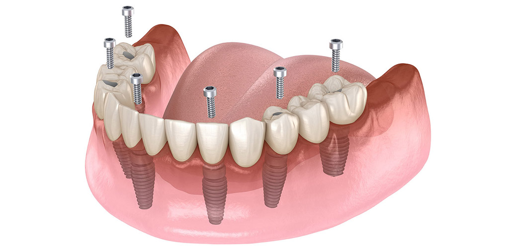 All On 6 dental implants treatment istanbul, turkey