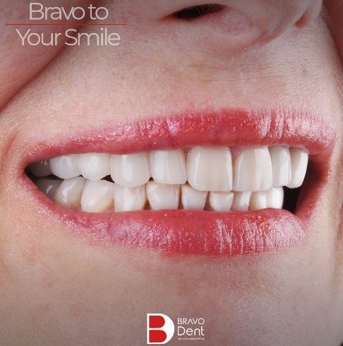 advantages-and-disadvantages-of-dental-implants-turkey-istanbul