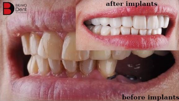 Benefits of Dental Implants in Turkey, Istanbul?