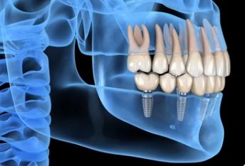 How long do dental implants treatments take in Turkey, Istanbul?