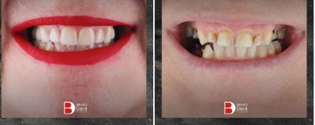 E-max Empress Dental Crowns & Veneers before after in Turkey, Istanbul