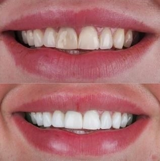 What can I do to improve my smile? in Turkey, Istanbul