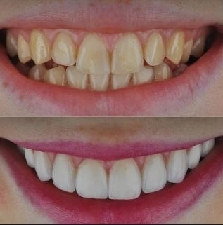 Ways to improve your smile in Turkey, Istanbul