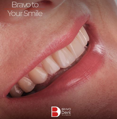 what-is-the-process-of-dental-laminate-veneers-turkey-istanbul